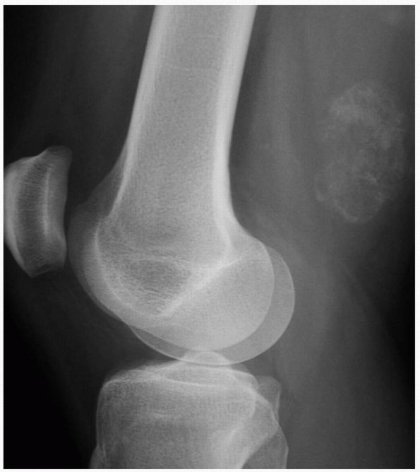 Musculoskeletal Neoplasms And Disorders That Resemble Neoplasms