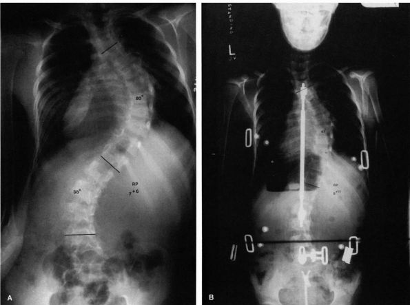 The Thoracolumbar Spine Teachme Orthopedics