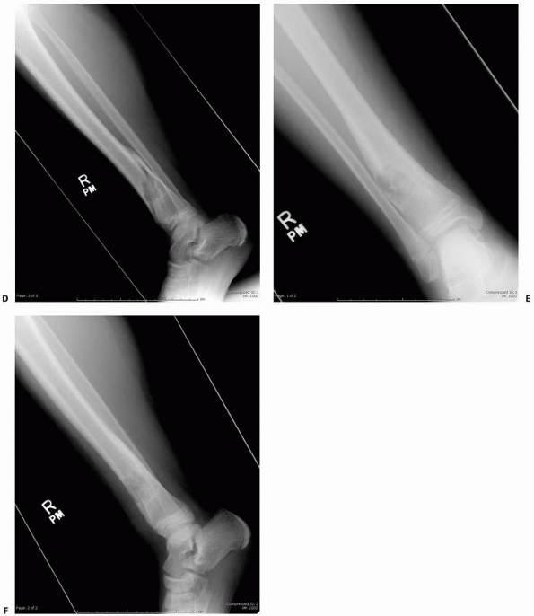 Pathologic Fractures Associated With Tumors And Unique Conditions Of