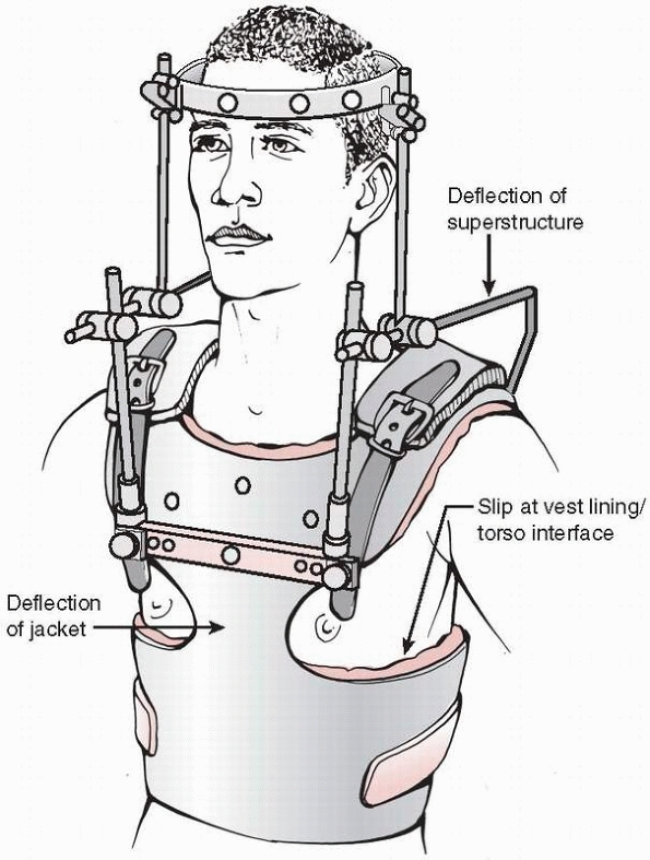 Biomechanics of Fractures and Fracture Fixation - TeachMe Orthopedics