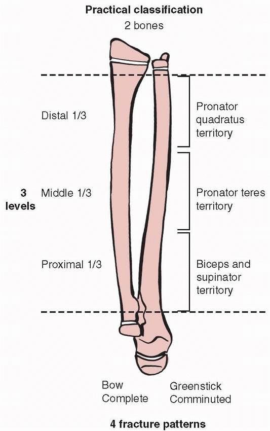 Injuries to the Shafts of the Radius and Ulna - TeachMe Orthopedics