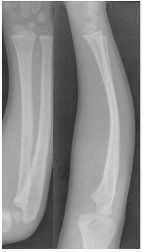 Injuries To The Shafts Of The Radius And Ulna Teachme Orthopedics 6260