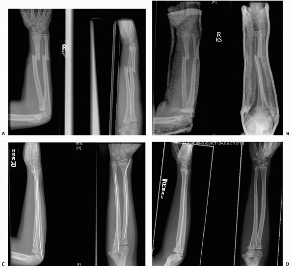 Injuries To The Shafts Of The Radius And Ulna Teachme Orthopedics 6313