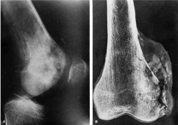 Musculoskeletal Neoplasms and Disorders That Resemble Neoplasms ...