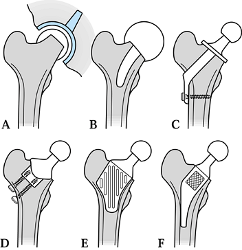 DESIGN AND PERFORMANCE OF JOINT REPLACEMENTS - TeachMe Orthopedics