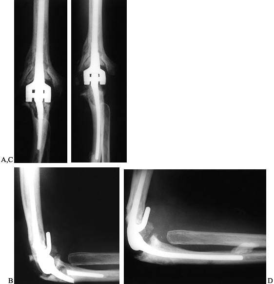 ARTHROPLASTY AND ARTHRODESIS OF THE ELBOW - TeachMe Orthopedics