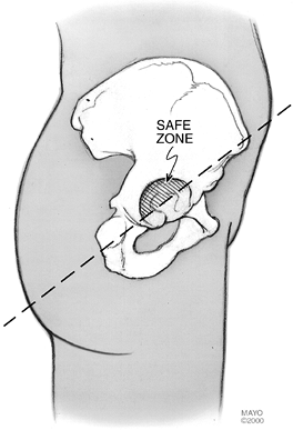 PRIMARY TOTAL HIP ARTHROPLASTY - TeachMe Orthopedics