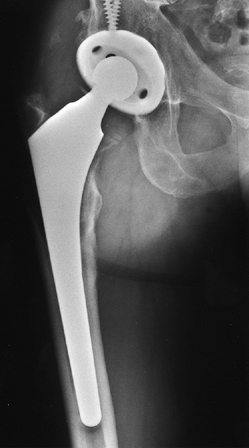 PRIMARY TOTAL HIP ARTHROPLASTY - TeachMe Orthopedics