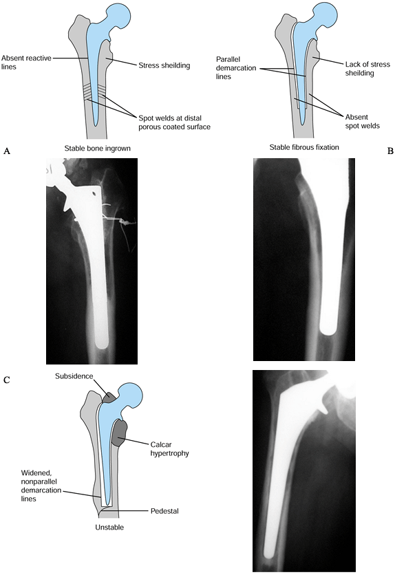 FAILED HIP ARTHROPLASTY: REVISION AND ARTHRODESIS - TeachMe Orthopedics