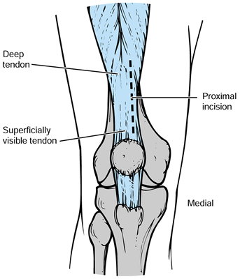 Primary Total Knee Arthroplasty - Teachme Orthopedics