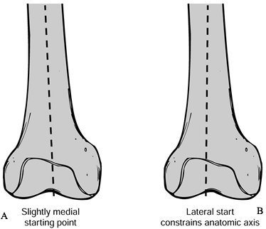 PRIMARY TOTAL KNEE ARTHROPLASTY - TeachMe Orthopedics