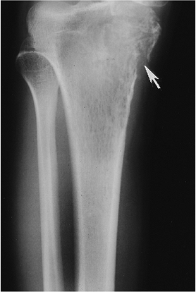 Musculoskeletal Neoplasms - TeachMe Orthopedics