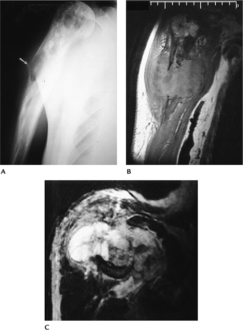 Musculoskeletal Neoplasms Teachme Orthopedics