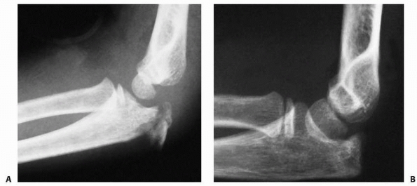 Fractures Of The Proximal Radius And Ulna - TeachMe Orthopedics