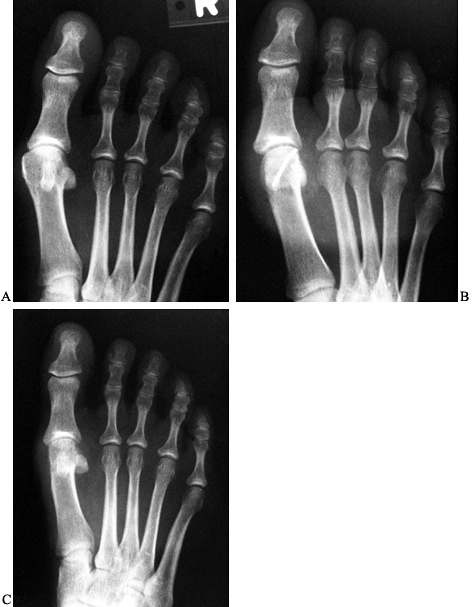 HALLUX VALGUS - TeachMe Orthopedics