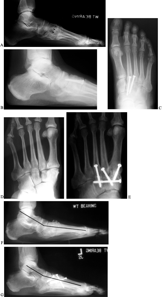 ARTHRODESES OF THE FOOT AND ANKLE TeachMe Orthopedics
