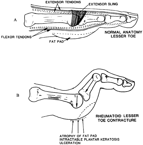 RHEUMATOID ARTHRITIS OF THE FOOT - TeachMe Orthopedics