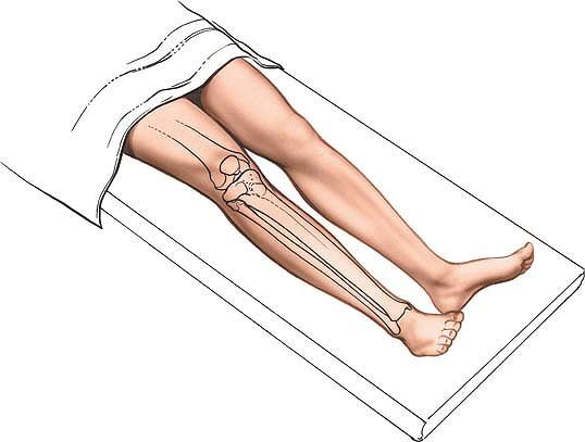 The Tibia and Fibula - TeachMe Orthopedics