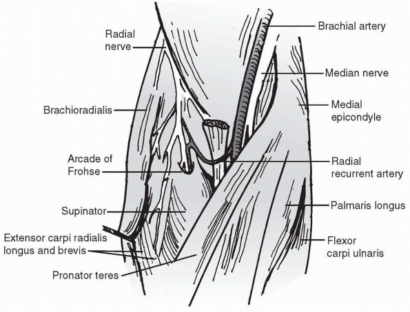 Monteggia Fracture-Dislocation in Children - TeachMe Orthopedics