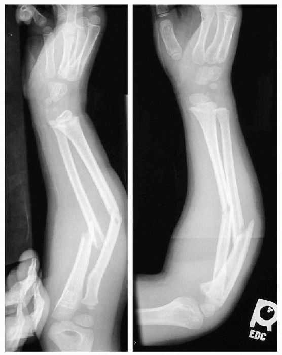 displaced fracture