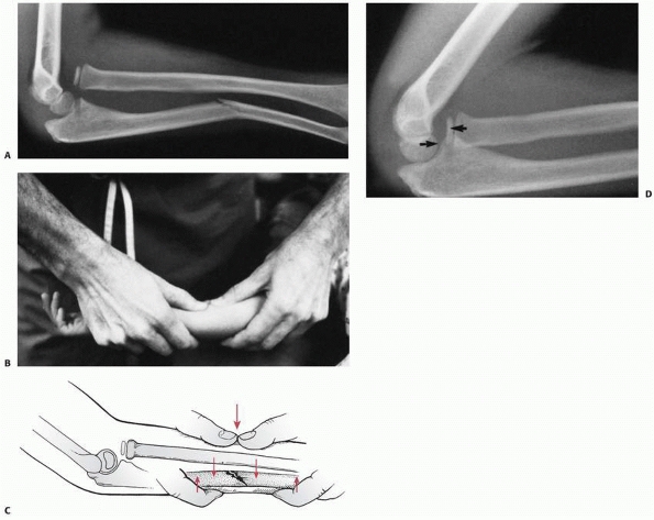 monteggia fracture icd 9