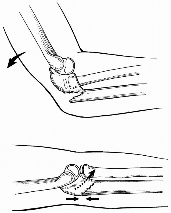 pdf steps to take monteggia fracture using mobile xray