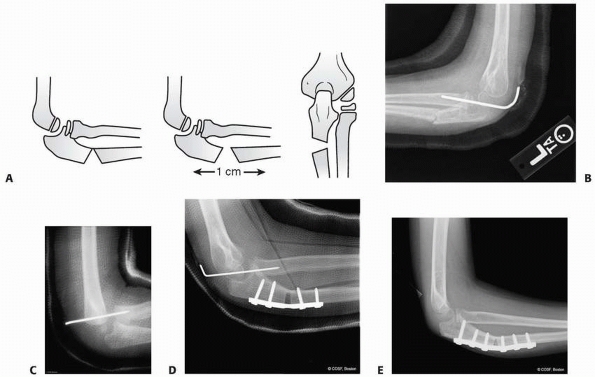 pdf steps to take monteggia fracture using mobile xray