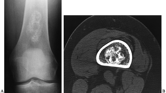 BENIGN BONE TUMORS - TeachMe Orthopedics