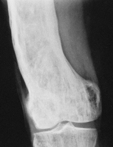 Metabolic Bone Disease - Teachme Orthopedics