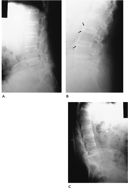 Arthropathies/Connective Tissue Diseases - TeachMe Orthopedics