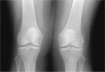 Arthropathies/Connective Tissue Diseases - TeachMe Orthopedics