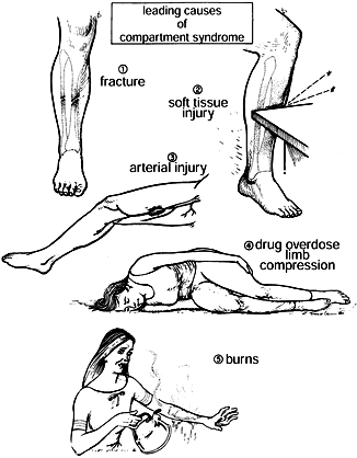 COMPARTMENT SYNDROMES - TeachMe Orthopedics