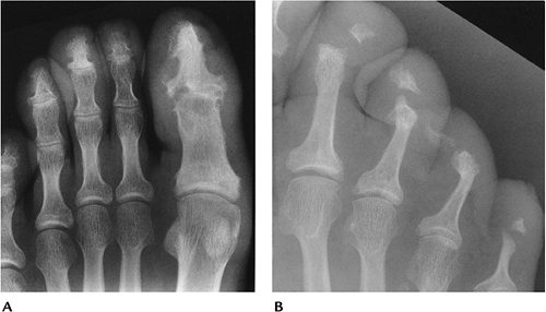 Arthropathies/Connective Tissue Diseases - TeachMe Orthopedics