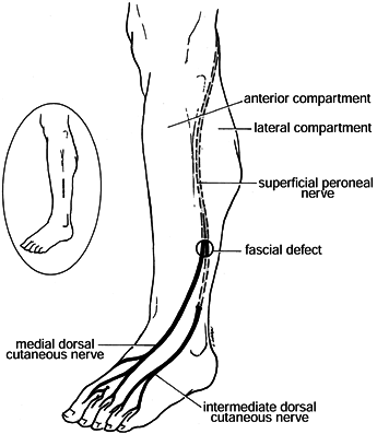 COMPARTMENT SYNDROMES - TeachMe Orthopedics