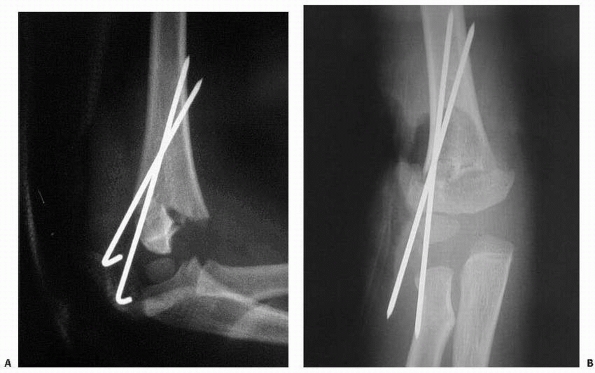 supracondylar fracture of humerus