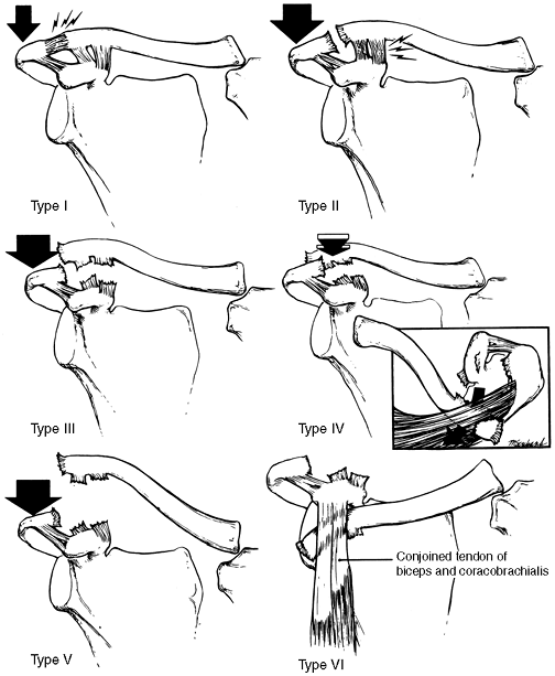 Sternoclavicular and Acromioclavicular Joint Injuries - TeachMe Orthopedics