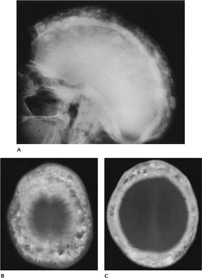 icd 10 pellucid marginal degeneration