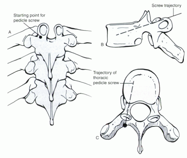 Thoracic Spondylosis, Stenosis, and DISC Herniations - TeachMe Orthopedics