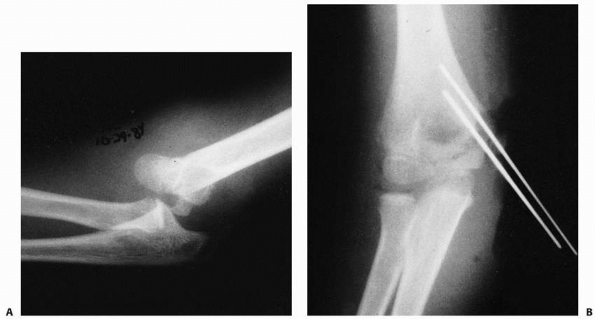 The Elbow: Physeal Fractures, Apophyseal Injuries of the Distal Humerus ...