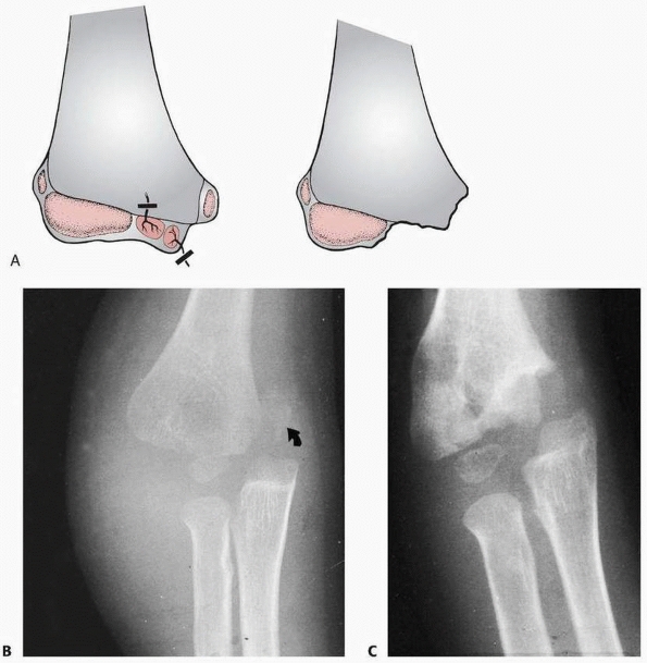 The Elbow: Physeal Fractures, Apophyseal Injuries of the Distal Humerus ...