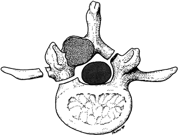 TUMORS OF THE SPINE - TeachMe Orthopedics