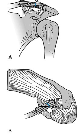 FRACTURES AND DISLOCATIONS OF THE SHOULDER GIRDLE AND HUMERUS - TeachMe ...