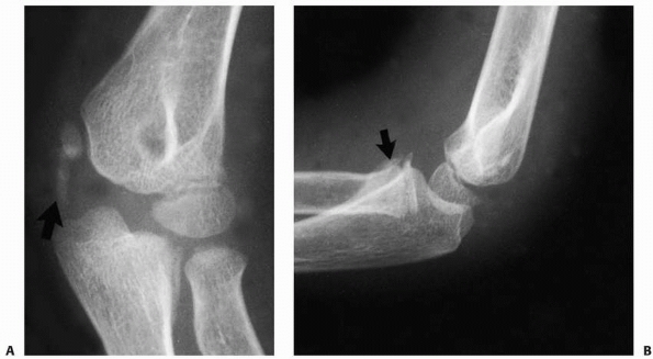 Dislocations Of The Elbow - TeachMe Orthopedics