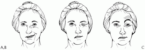 Examination of Facial Strength - TeachMe Orthopedics