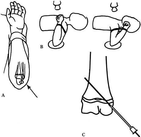 OPERATIVE TREATMENT OF CHILDREN'S FRACTURES AND INJURIES OF THE PHYSES ...