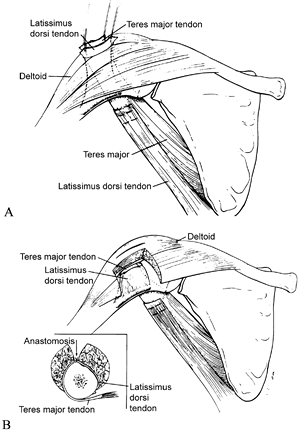 Congenital Shoulder And Elbow Malformations And Deformities - Teachme 