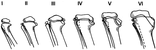 ANGULAR DEFORMITIES OF THE LOWER EXTREMITIES IN CHILDREN - TeachMe ...