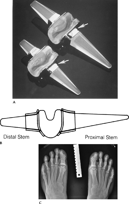 Orthopedic Appliances And Prostheses TeachMe Orthopedics   C16FF38 2 