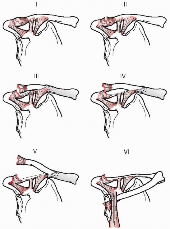 Proximal Humerus, Scapula, and Clavicle - TeachMe Orthopedics