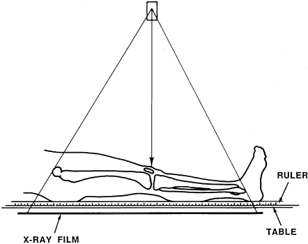 LIMB-LENGTH DISCREPANCY IN CHILDREN - TeachMe Orthopedics